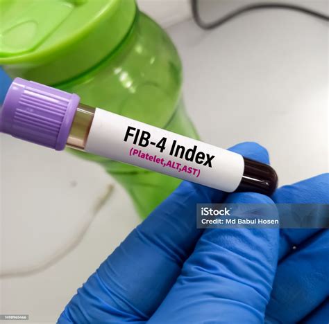 fib 4 blood test bottle|why fib 4 is used.